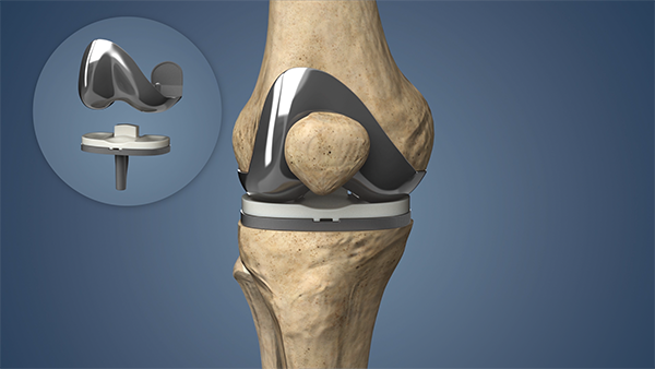 Knee Replacement Recovery Timeline: What to Expect