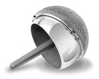Hip Surface Replacement