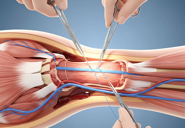 Tendon Repair Surgery